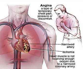 coronary-heart-disease-symptoms
